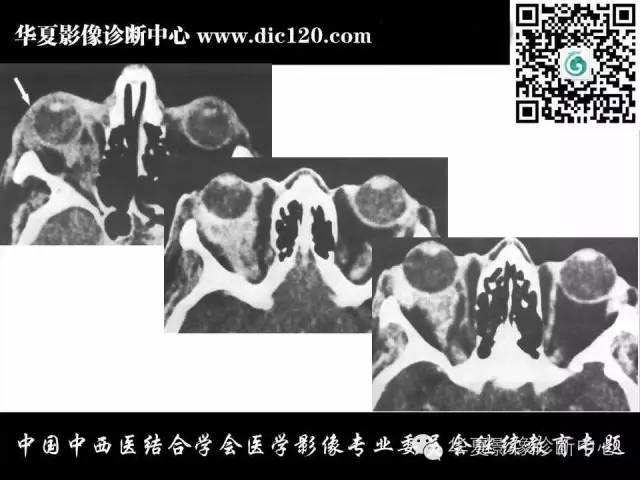 【PPT】眼及眼眶常见病变的影像诊断