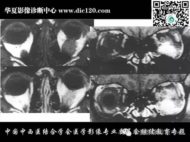 【PPT】眼及眼眶常见病变的影像诊断