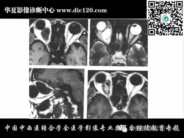 【PPT】眼及眼眶常见病变的影像诊断