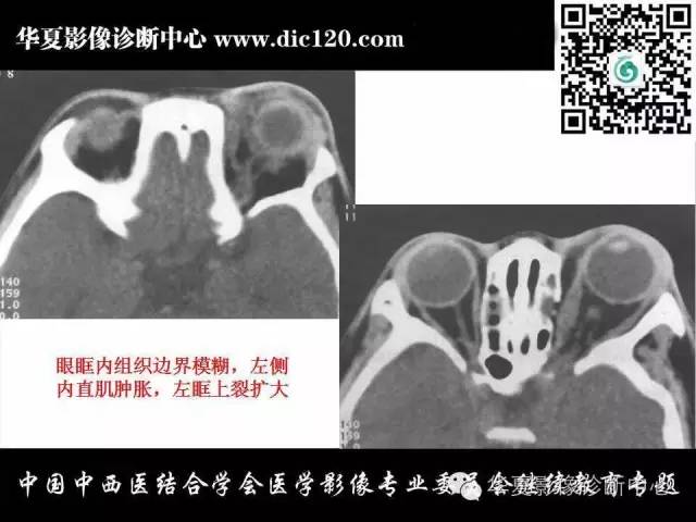 【PPT】眼及眼眶常见病变的影像诊断