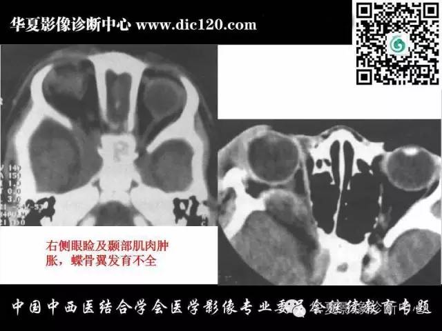 【PPT】眼及眼眶常见病变的影像诊断