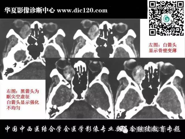 【PPT】眼及眼眶常见病变的影像诊断