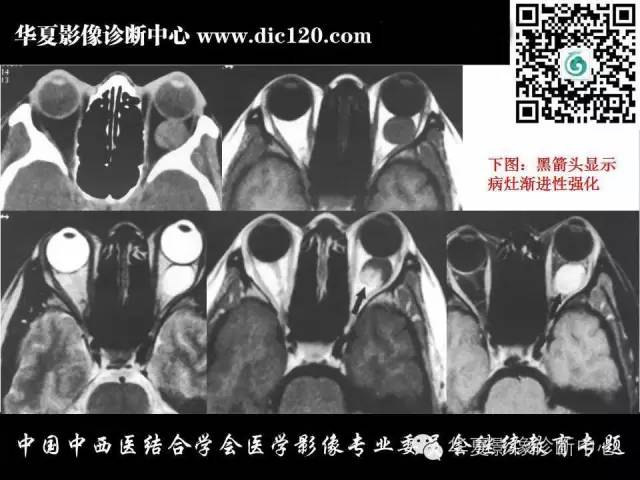 【PPT】眼及眼眶常见病变的影像诊断