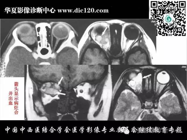 【PPT】眼及眼眶常见病变的影像诊断
