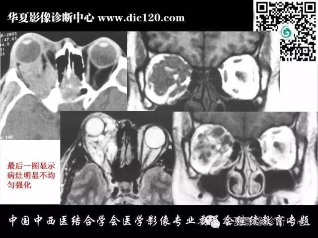 【PPT】眼及眼眶常见病变的影像诊断