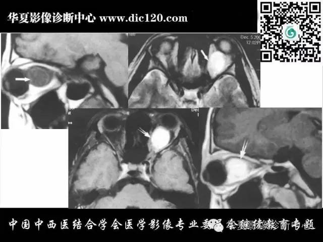 【PPT】眼及眼眶常见病变的影像诊断