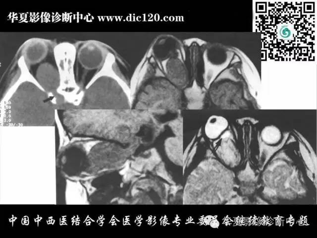 【PPT】眼及眼眶常见病变的影像诊断