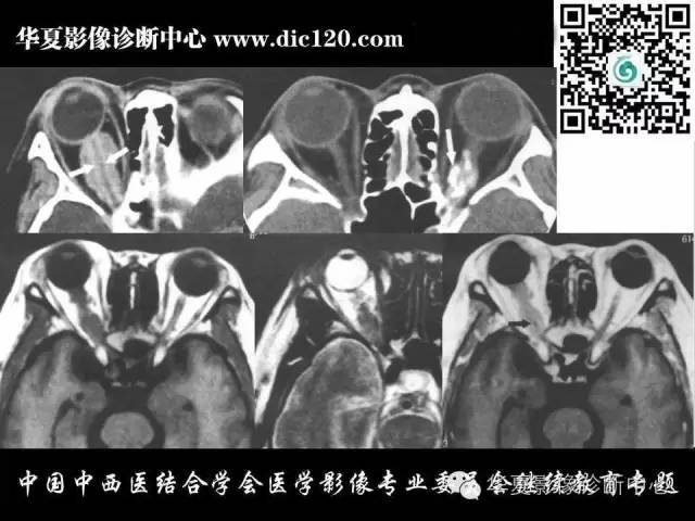 【PPT】眼及眼眶常见病变的影像诊断