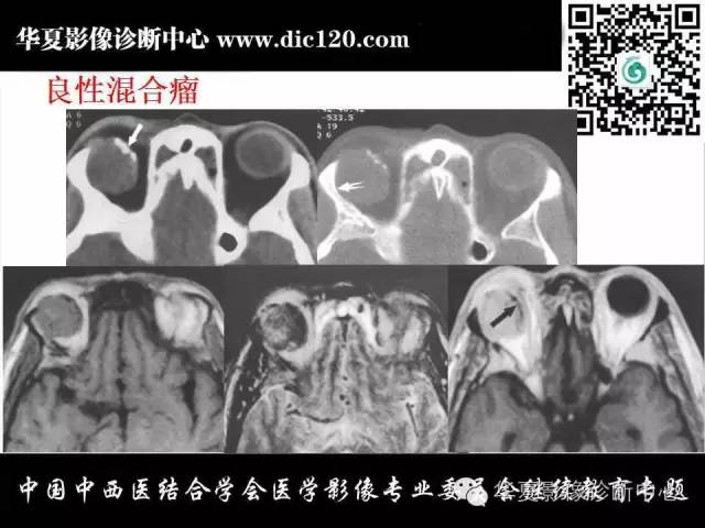 【PPT】眼及眼眶常见病变的影像诊断