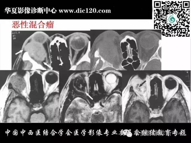 【PPT】眼及眼眶常见病变的影像诊断