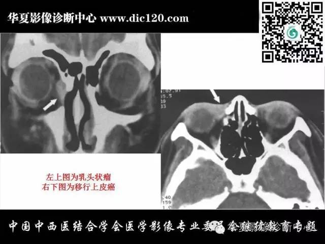 【PPT】眼及眼眶常见病变的影像诊断