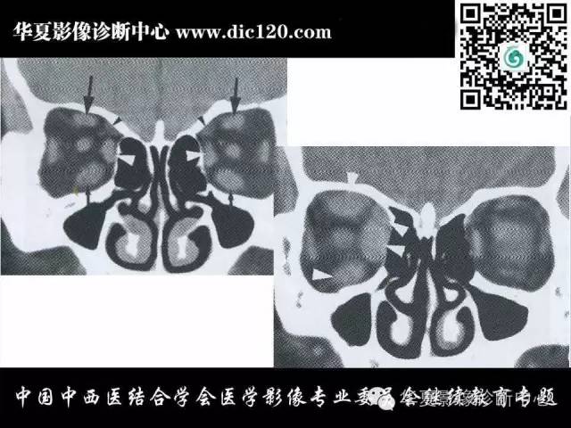 【PPT】眼及眼眶常见病变的影像诊断