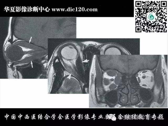 【PPT】眼及眼眶常见病变的影像诊断