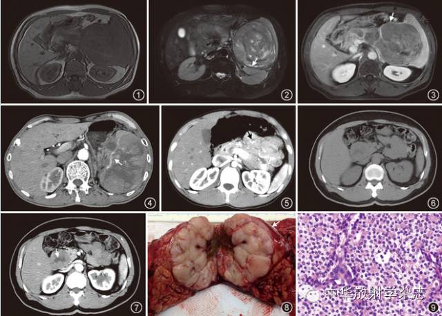 胰腺腺泡细胞癌的CT、MRI表现特征