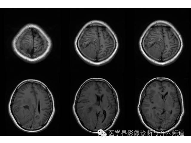 【病例】右顶叶原始神经外胚层瘤PNET一例MR影像表现 【病例】右顶叶原始神经外胚层瘤PNET一例MR影像表现