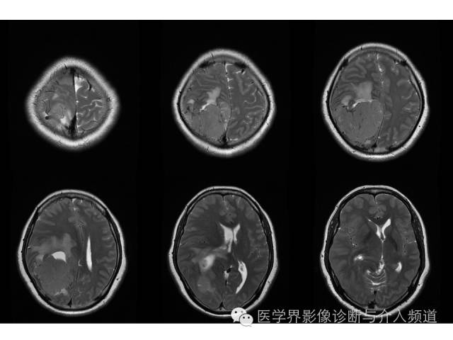 【病例】右顶叶原始神经外胚层瘤PNET一例MR影像表现