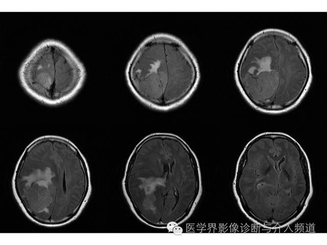 【病例】右顶叶原始神经外胚层瘤PNET一例MR影像表现 【病例】右顶叶原始神经外胚层瘤PNET一例MR影像表现