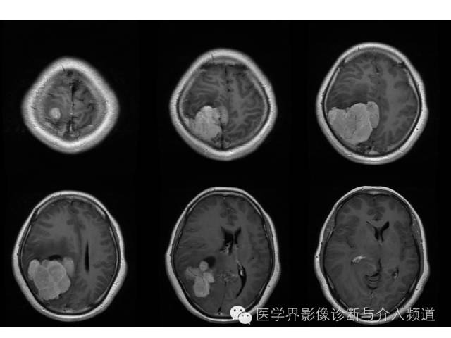 【病例】右顶叶原始神经外胚层瘤PNET一例MR影像表现 【病例】右顶叶原始神经外胚层瘤PNET一例MR影像表现