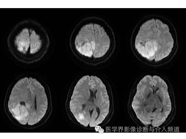 【病例】右顶叶原始神经外胚层瘤PNET一例MR影像表现 【病例】右顶叶原始神经外胚层瘤PNET一例MR影像表现