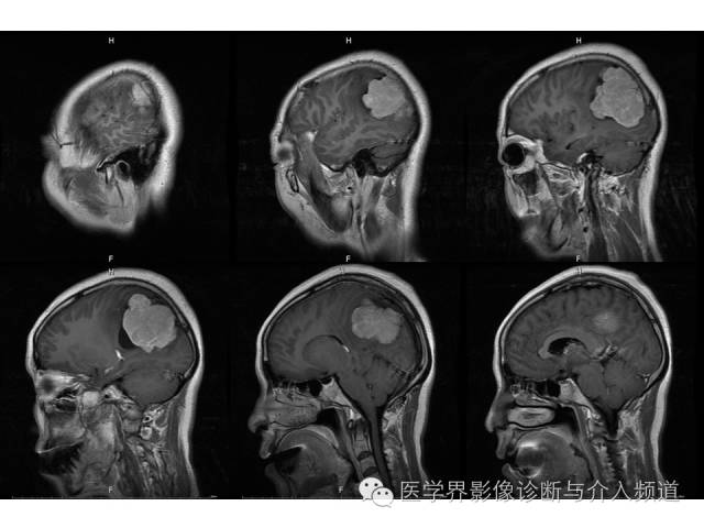【病例】右顶叶原始神经外胚层瘤PNET一例MR影像表现 【病例】右顶叶原始神经外胚层瘤PNET一例MR影像表现