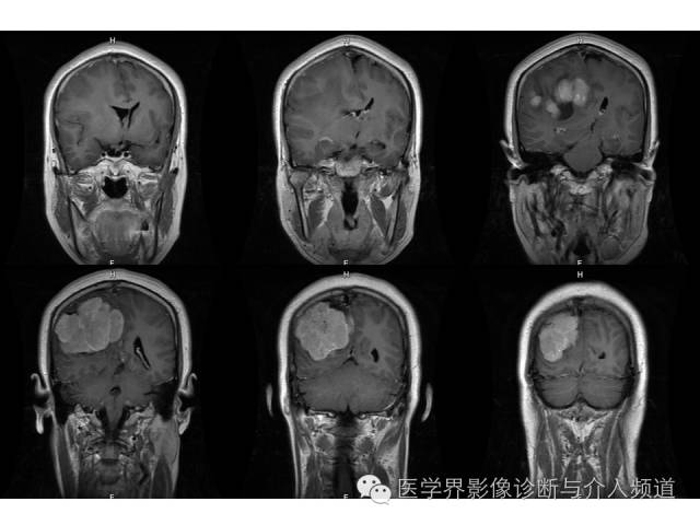 【病例】右顶叶原始神经外胚层瘤PNET一例MR影像表现 【病例】右顶叶原始神经外胚层瘤PNET一例MR影像表现