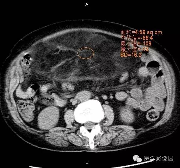 【病例】腹膜后脂肪肉瘤1例CT影像表现
