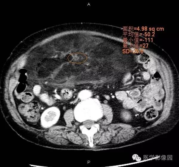 【病例】腹膜后脂肪肉瘤1例CT影像表现 【病例】腹膜后脂肪肉瘤1例CT影像表现