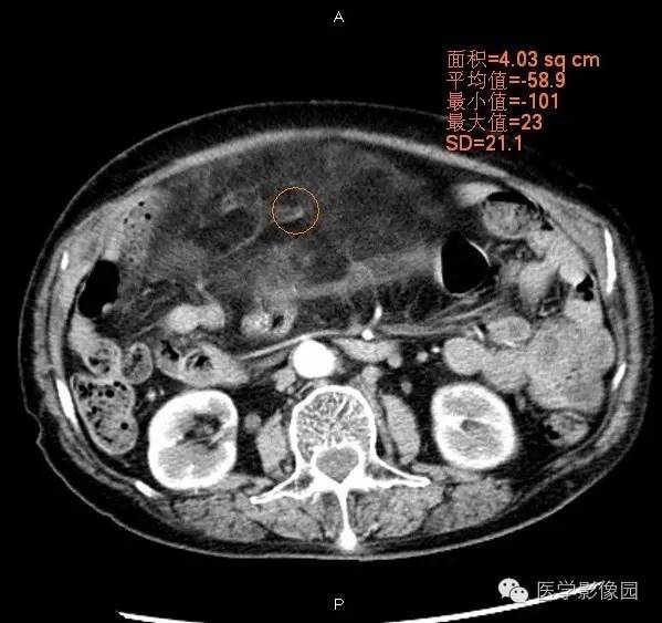 【病例】腹膜后脂肪肉瘤1例CT影像表现 【病例】腹膜后脂肪肉瘤1例CT影像表现