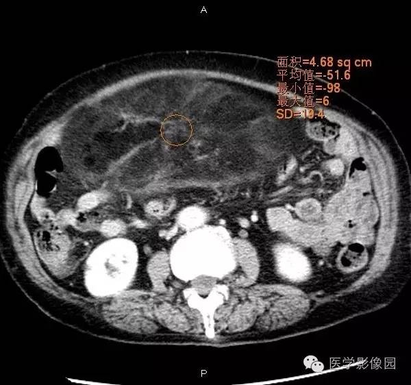 【病例】腹膜后脂肪肉瘤1例CT影像表现 【病例】腹膜后脂肪肉瘤1例CT影像表现