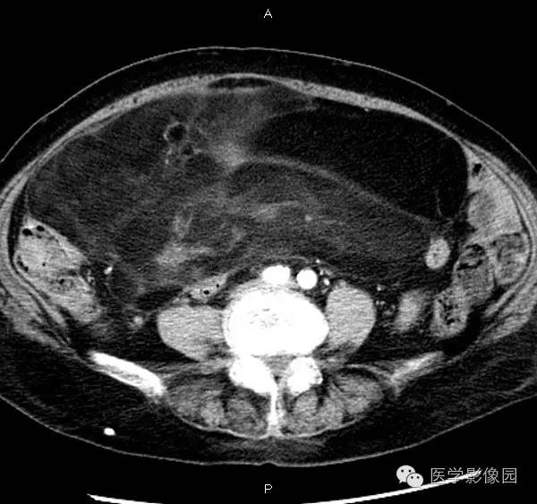 【病例】腹膜后脂肪肉瘤1例CT影像表现 【病例】腹膜后脂肪肉瘤1例CT影像表现