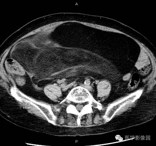 【病例】腹膜后脂肪肉瘤1例CT影像表现 【病例】腹膜后脂肪肉瘤1例CT影像表现