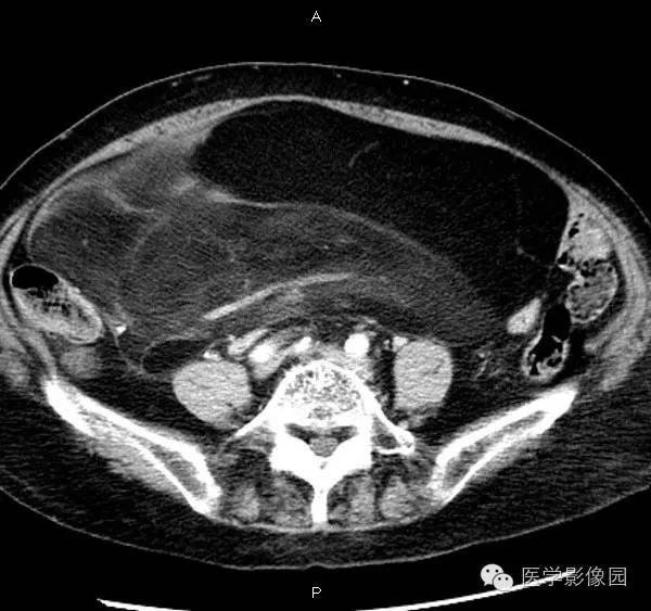 【病例】腹膜后脂肪肉瘤1例CT影像表现 【病例】腹膜后脂肪肉瘤1例CT影像表现