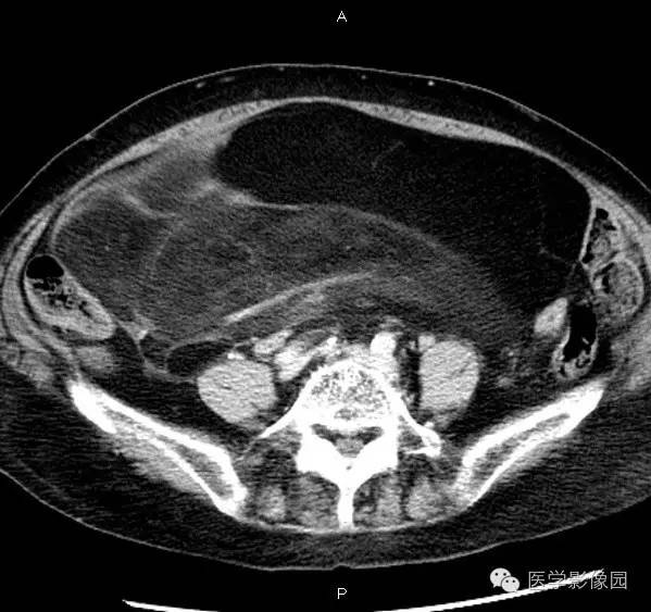 【病例】腹膜后脂肪肉瘤1例CT影像表现 【病例】腹膜后脂肪肉瘤1例CT影像表现