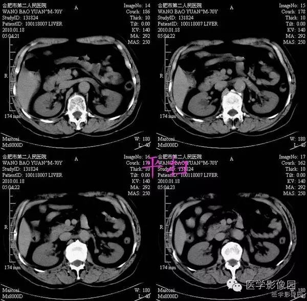 【病例】胸腹主动脉夹层1例CT影像表现 【病例】胸腹主动脉夹层1例CT影像表现