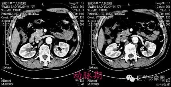【病例】胸腹主动脉夹层1例CT影像表现 【病例】胸腹主动脉夹层1例CT影像表现