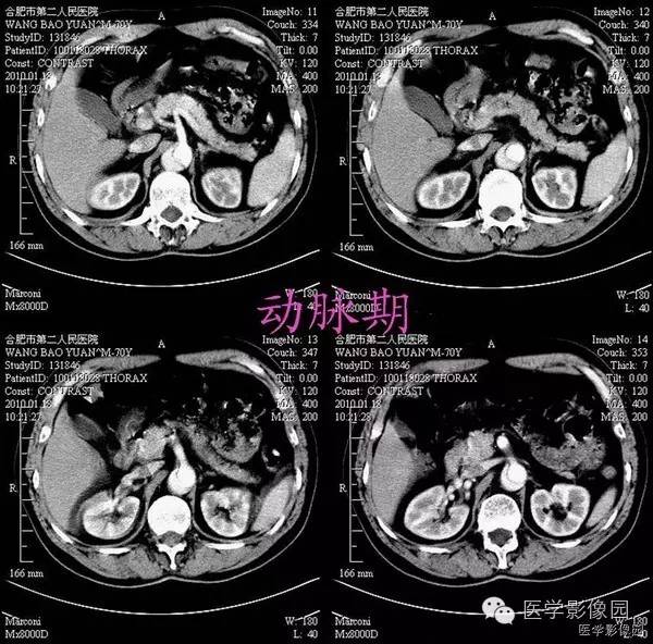 【病例】胸腹主动脉夹层1例CT影像表现 【病例】胸腹主动脉夹层1例CT影像表现