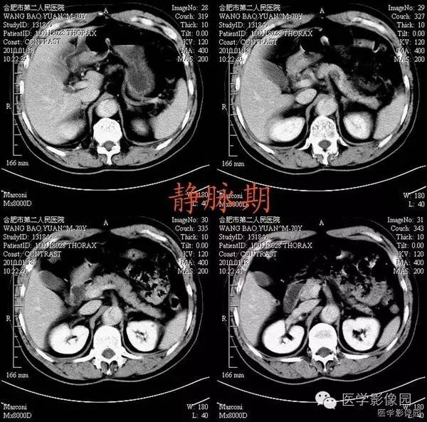 【病例】胸腹主动脉夹层1例CT影像表现 【病例】胸腹主动脉夹层1例CT影像表现
