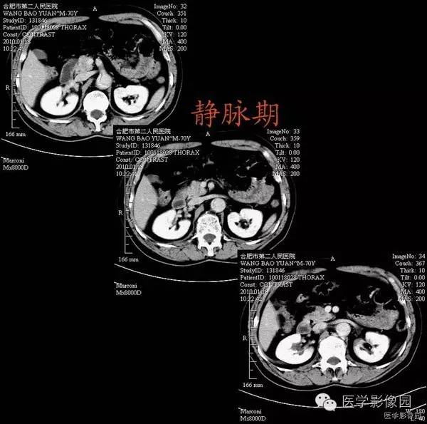 【病例】胸腹主动脉夹层1例CT影像表现 【病例】胸腹主动脉夹层1例CT影像表现