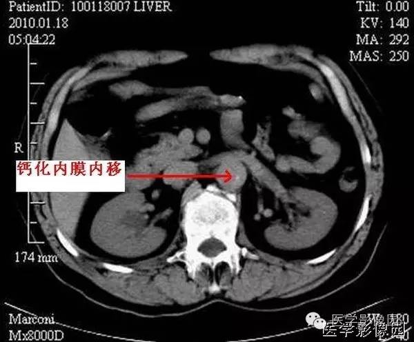 【病例】胸腹主动脉夹层1例CT影像表现 【病例】胸腹主动脉夹层1例CT影像表现