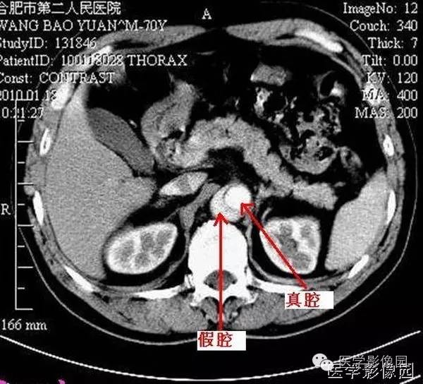 【病例】胸腹主动脉夹层1例CT影像表现 【病例】胸腹主动脉夹层1例CT影像表现