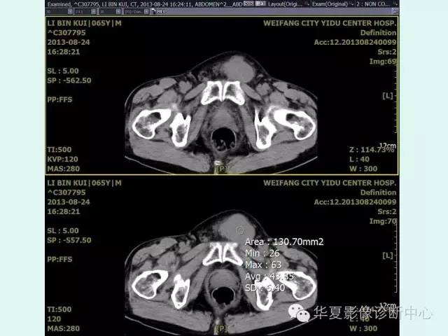 【病例】睾丸肿瘤2例CT
