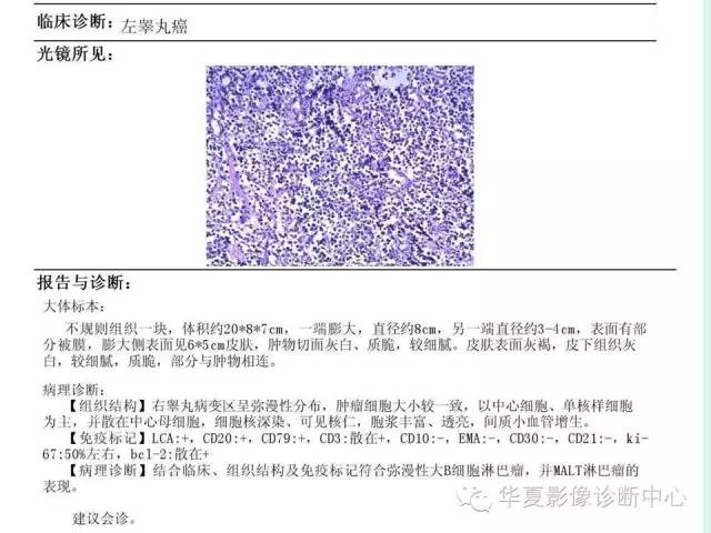 【病例】睾丸肿瘤2例CT