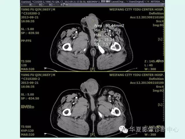 【病例】睾丸肿瘤2例CT