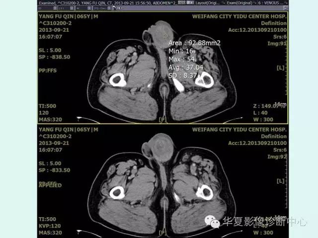 【病例】睾丸肿瘤2例CT