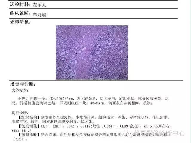 【病例】睾丸肿瘤2例CT