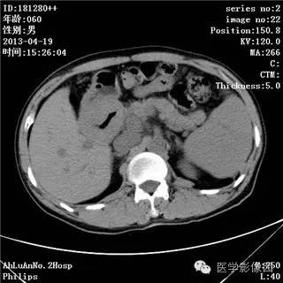 【病例】十二指肠粘膜相关淋巴瘤1例CT影像表现