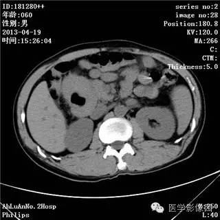 【病例】十二指肠粘膜相关淋巴瘤1例CT影像表现