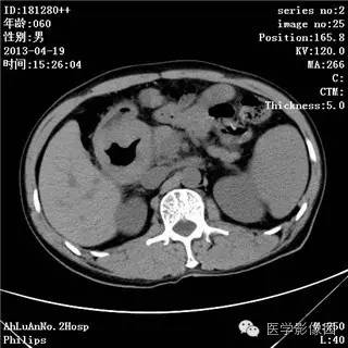【病例】十二指肠粘膜相关淋巴瘤1例CT影像表现