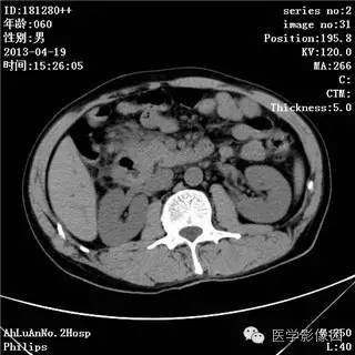 【病例】十二指肠粘膜相关淋巴瘤1例CT影像表现