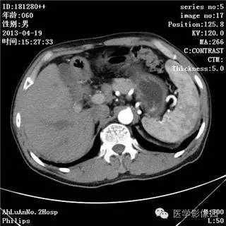 【病例】十二指肠粘膜相关淋巴瘤1例CT影像表现